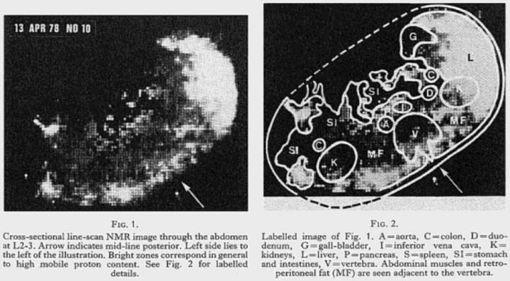 the first MRI body scan